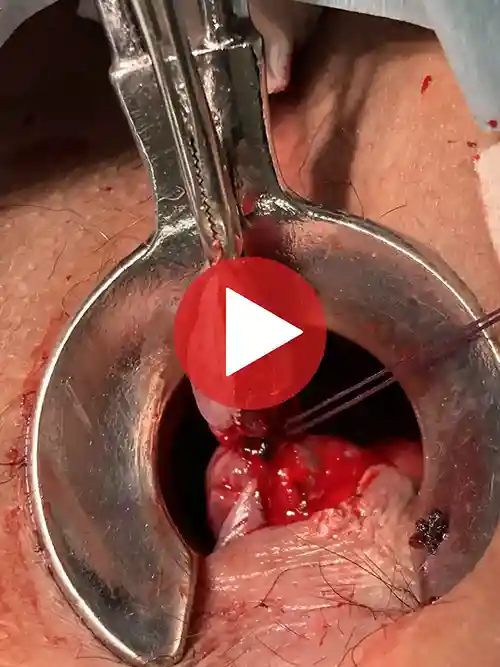 6時方向痔核切除の写真