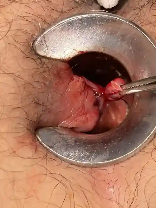 8時方向痔核切除の写真