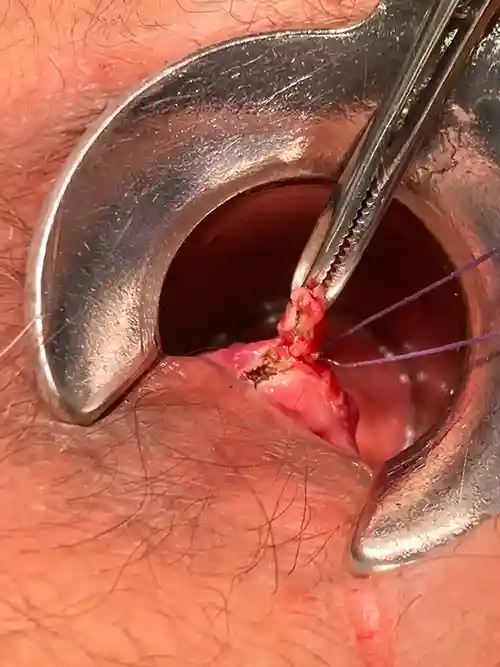 7時方向痔核切除の写真