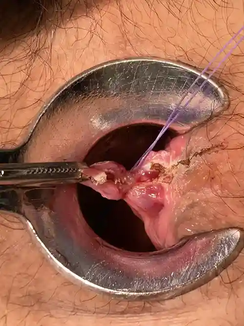 3時方向痔核切除の写真