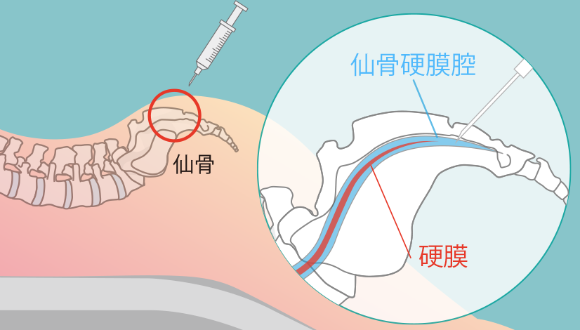 仙骨硬膜外麻酔