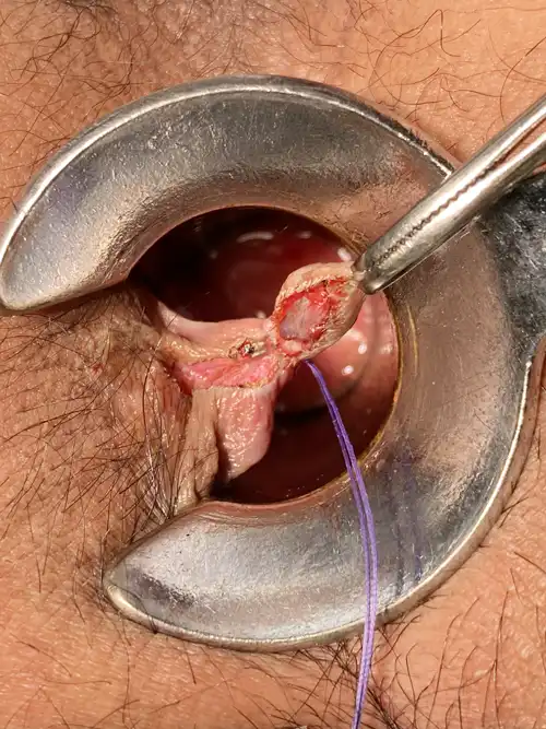 7時方向痔核切除の写真