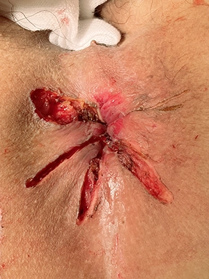 スキンタグ手術直後の写真