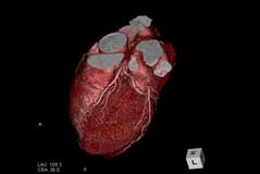 冠動脈ＣＴ画像