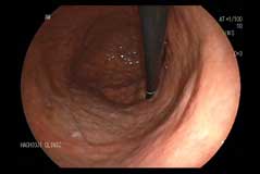 経鼻内視鏡撮影画像