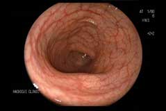 大腸内視鏡検査撮影画像