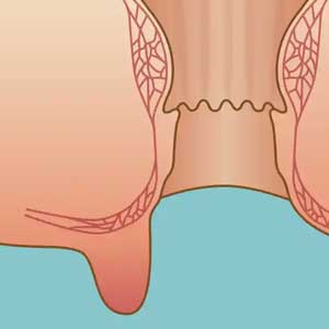 スキンタグ手術