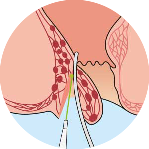 詳細 クランプトレーザー法