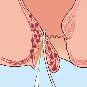 低侵襲手術の技術のリンクボタン
